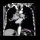 Lung tumour, hilar lymphadenopathy: CT - Computed tomography